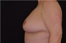 Breast Reduction After Photo by Landon Pryor, MD, FACS; Rockford, IL - Case 37954