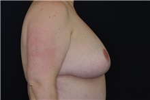 Breast Reduction After Photo by Landon Pryor, MD, FACS; Rockford, IL - Case 37954