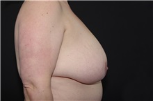 Breast Reduction Before Photo by Landon Pryor, MD, FACS; Rockford, IL - Case 37954