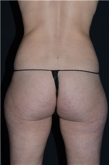 Liposuction Before Photo by Landon Pryor, MD, FACS; Rockford, IL - Case 37958