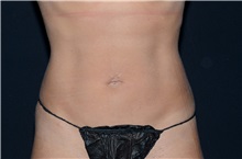 Liposuction After Photo by Landon Pryor, MD, FACS; Rockford, IL - Case 37958
