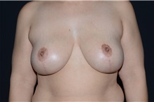 Breast Reduction After Photo by Landon Pryor, MD, FACS; Rockford, IL - Case 37959