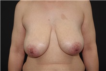 Breast Reduction Before Photo by Landon Pryor, MD, FACS; Rockford, IL - Case 37959