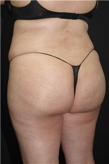 Buttock Lift with Augmentation After Photo by Landon Pryor, MD, FACS; Rockford, IL - Case 37963