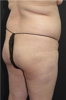 Buttock Lift with Augmentation Before Photo by Landon Pryor, MD, FACS; Rockford, IL - Case 37963
