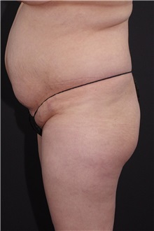 Buttock Lift with Augmentation Before Photo by Landon Pryor, MD, FACS; Rockford, IL - Case 37963