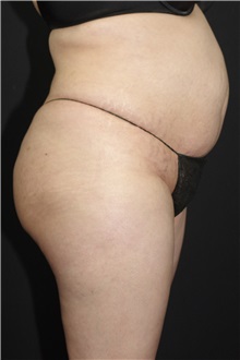 Buttock Lift with Augmentation After Photo by Landon Pryor, MD, FACS; Rockford, IL - Case 37963