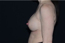Breast Augmentation After Photo by Landon Pryor, MD, FACS; Rockford, IL - Case 37964