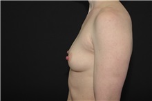 Breast Augmentation Before Photo by Landon Pryor, MD, FACS; Rockford, IL - Case 37964