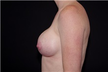 Breast Augmentation After Photo by Landon Pryor, MD, FACS; Rockford, IL - Case 37966