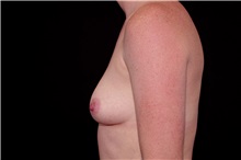 Breast Augmentation Before Photo by Landon Pryor, MD, FACS; Rockford, IL - Case 37966