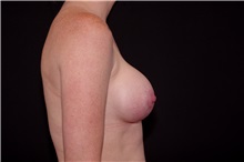 Breast Augmentation After Photo by Landon Pryor, MD, FACS; Rockford, IL - Case 37966