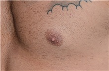 Male Breast Reduction Before Photo by Landon Pryor, MD, FACS; Rockford, IL - Case 37970