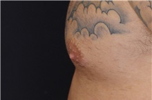 Male Breast Reduction After Photo by Landon Pryor, MD, FACS; Rockford, IL - Case 37970