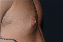 Male Breast Reduction Before Photo by Landon Pryor, MD, FACS; Rockford, IL - Case 37970