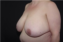 Breast Reduction Before Photo by Landon Pryor, MD, FACS; Rockford, IL - Case 37972