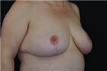 Breast Reduction After Photo by Landon Pryor, MD, FACS; Rockford, IL - Case 37972