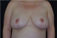 Breast Reduction After Photo by Landon Pryor, MD, FACS; Rockford, IL - Case 37972