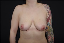 Breast Augmentation Before Photo by Landon Pryor, MD, FACS; Rockford, IL - Case 37973