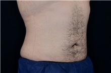 Liposuction After Photo by Landon Pryor, MD, FACS; Rockford, IL - Case 37974