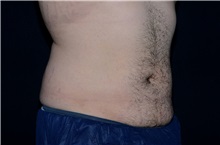 Liposuction Before Photo by Landon Pryor, MD, FACS; Rockford, IL - Case 37974