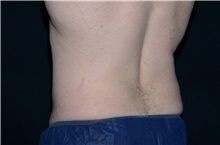 Liposuction Before Photo by Landon Pryor, MD, FACS; Rockford, IL - Case 37974