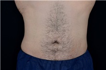 Liposuction After Photo by Landon Pryor, MD, FACS; Rockford, IL - Case 37974