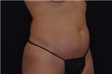 Liposuction Before Photo by Landon Pryor, MD, FACS; Rockford, IL - Case 38149