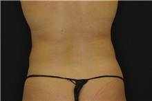 Liposuction After Photo by Landon Pryor, MD, FACS; Rockford, IL - Case 38149