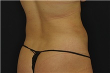 Liposuction After Photo by Landon Pryor, MD, FACS; Rockford, IL - Case 38149
