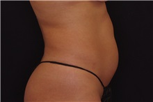 Liposuction Before Photo by Landon Pryor, MD, FACS; Rockford, IL - Case 38149