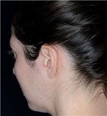 Ear Surgery Before Photo by Landon Pryor, MD, FACS; Rockford, IL - Case 38150