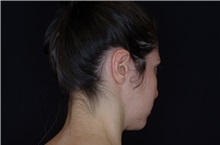 Ear Surgery After Photo by Landon Pryor, MD, FACS; Rockford, IL - Case 38150