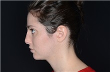 Ear Surgery Before Photo by Landon Pryor, MD, FACS; Rockford, IL - Case 38150