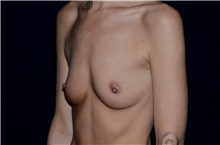 Breast Augmentation Before Photo by Landon Pryor, MD, FACS; Rockford, IL - Case 38152