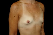 Breast Augmentation Before Photo by Landon Pryor, MD, FACS; Rockford, IL - Case 38160
