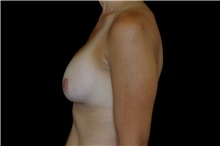 Breast Augmentation After Photo by Landon Pryor, MD, FACS; Rockford, IL - Case 38160