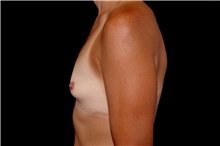 Breast Augmentation Before Photo by Landon Pryor, MD, FACS; Rockford, IL - Case 38160
