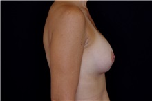 Breast Augmentation After Photo by Landon Pryor, MD, FACS; Rockford, IL - Case 38160