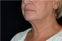 Liposuction After Photo by Landon Pryor, MD, FACS; Rockford, IL - Case 38161
