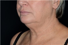 Liposuction Before Photo by Landon Pryor, MD, FACS; Rockford, IL - Case 38161