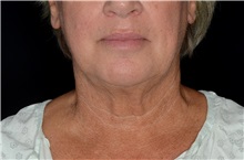 Liposuction After Photo by Landon Pryor, MD, FACS; Rockford, IL - Case 38161