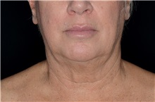 Liposuction Before Photo by Landon Pryor, MD, FACS; Rockford, IL - Case 38161