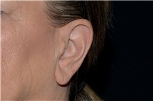 Ear Surgery Before Photo by Landon Pryor, MD, FACS; Rockford, IL - Case 38162