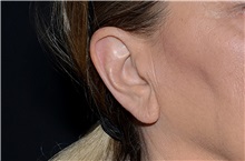 Ear Surgery Before Photo by Landon Pryor, MD, FACS; Rockford, IL - Case 38162