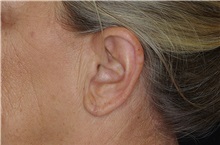 Ear Surgery After Photo by Landon Pryor, MD, FACS; Rockford, IL - Case 38162