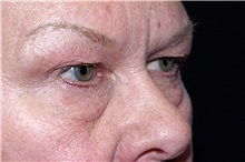 Eyelid Surgery Before Photo by Landon Pryor, MD, FACS; Rockford, IL - Case 38165