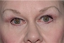 Eyelid Surgery After Photo by Landon Pryor, MD, FACS; Rockford, IL - Case 38165