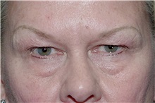 Eyelid Surgery Before Photo by Landon Pryor, MD, FACS; Rockford, IL - Case 38165