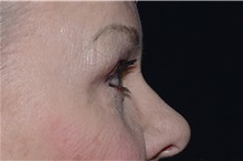 Eyelid Surgery After Photo by Landon Pryor, MD, FACS; Rockford, IL - Case 38165
